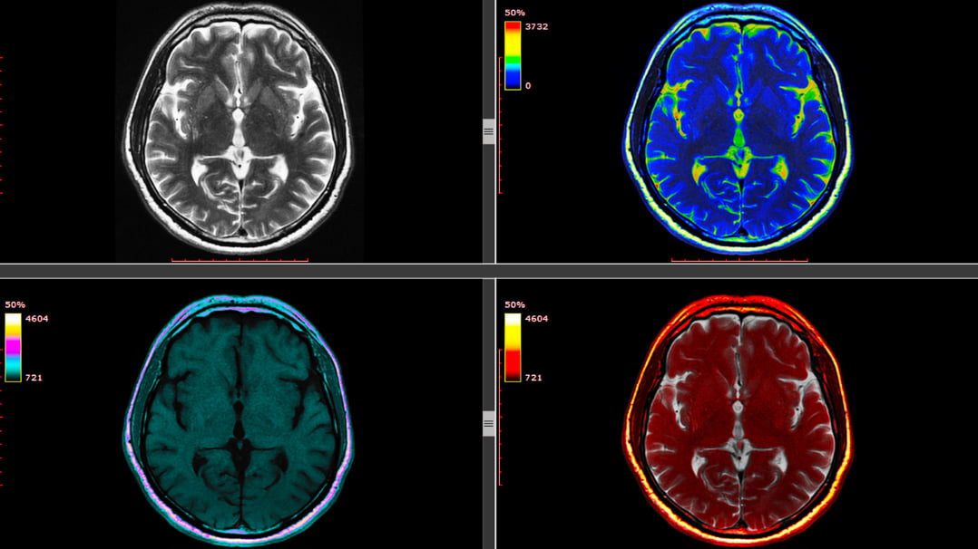 What Does Meditation Do to the Brain? – The Exact Science Behind It